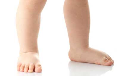 تشخیص کف پای صاف در کودکان، درمان صافی کف پا در کودکان، درمان صافی کف پا در طب سنتی،  کفش مخصوص کف پای صاف،  فوق تخصص صافی کف پا،  تشخیص کف پای صاف،  عکس از صافی کف پا،  برای درمان کف پای صاف به چه دکتری باید مراجعه کرد،  کلینیک تخصصی پای کودکان