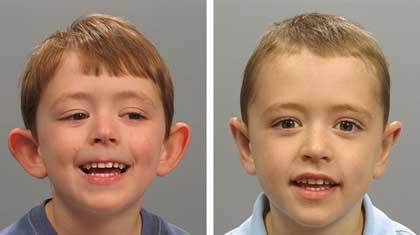 عمل جراحی زیبایی گوش کودکان از چند سالگی؟، عوارض عمل جراحی زیبایی گوش کودکان