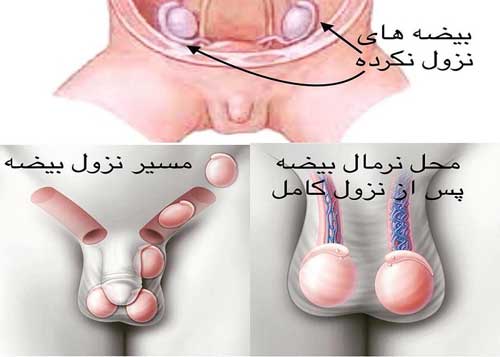 بهترین زمان عمل بیضه نزول نکرده