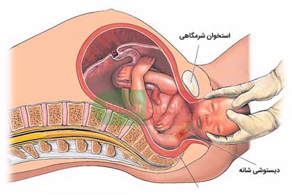 عوارض دیستوشی شانه