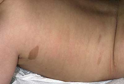 نوروفیبروماتوز در نوزادان، لکه های شیر قهوه ای در نوزادان