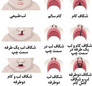 جلوگیری از لب شکری شدن جنین،  آیا لب شکری ارثی است؟، پیشگیری از لب شکری،  آزمایش ژنتیک برای لب شکری،  تشخیص لب شکری در غربالگری،  علت لب شکری شدن نوزاد،  تشخیص لب شکری نوزاد از طریق سونوگرافی غربالگری، 