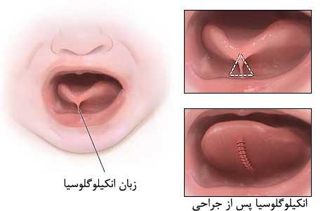 علت چسبیدن زبان نوزاد به سقف دهان