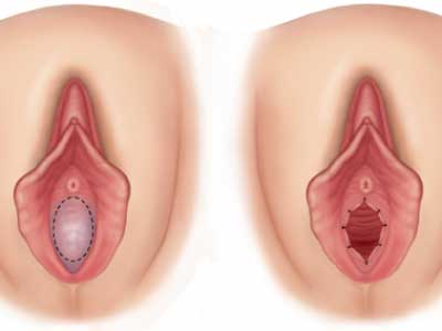 فاصله دهانه واژن تا بكارت، فاصله ورودی واژن تا دهانه رحم، فاصله دهانه رحم تا واژن
