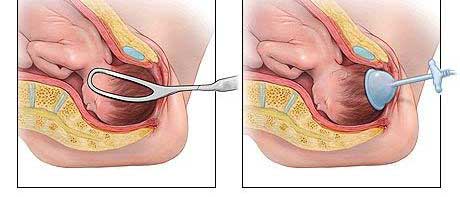 عوارض استفاده از وکیوم در زایمان طبیعی