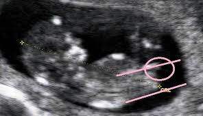 عکس اندام تناسلی جنین دختر