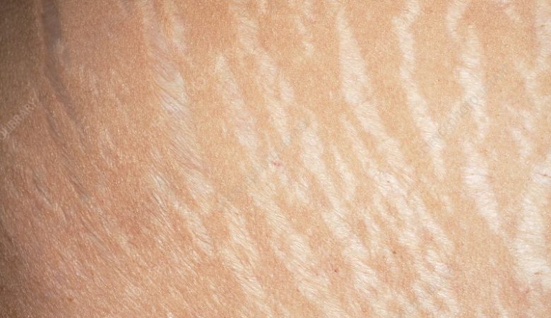 رفع ترک های پوستی: 18 درمان خانگی و 6 درمان پزشکی