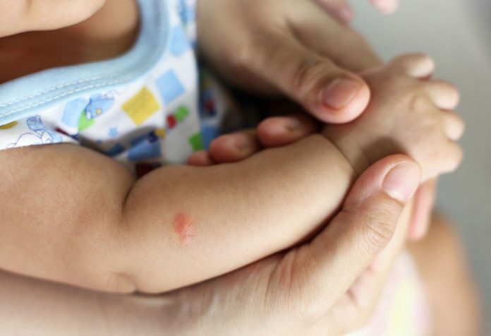 9 درمان خانگی کورک در نوزادان