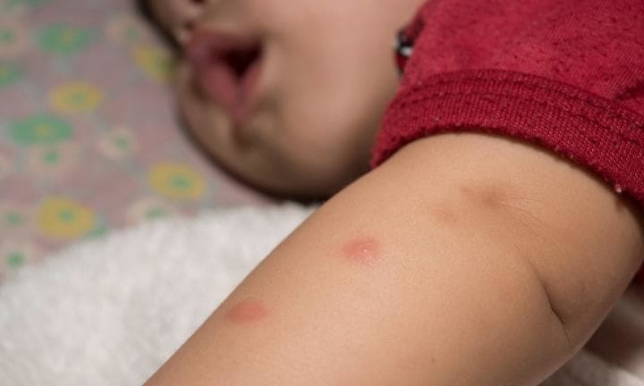 7 درمان خانگی برای نیش پشه در کودکان
