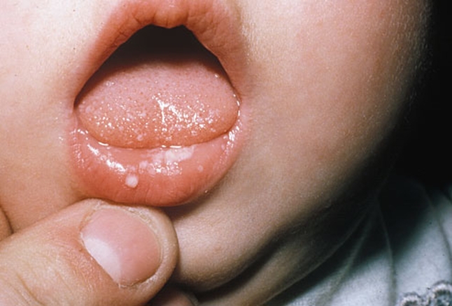 علل، علائم و درمان عفونت های قارچی در نوزادان