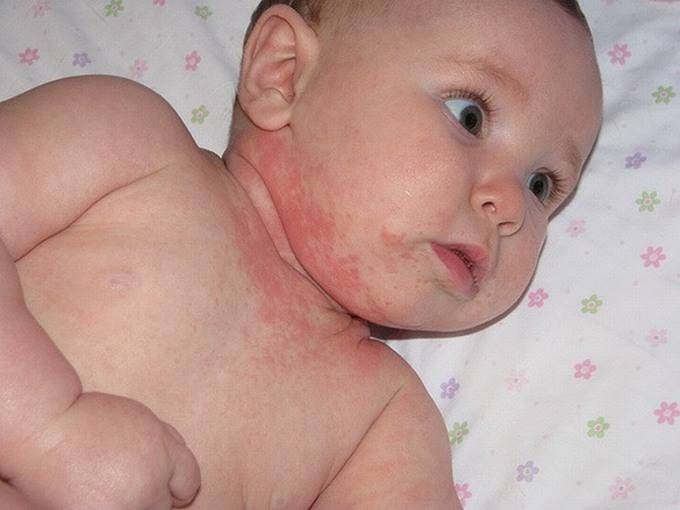 اگر کودک شما به لبنیات آلرژی داشته باشد چه؟