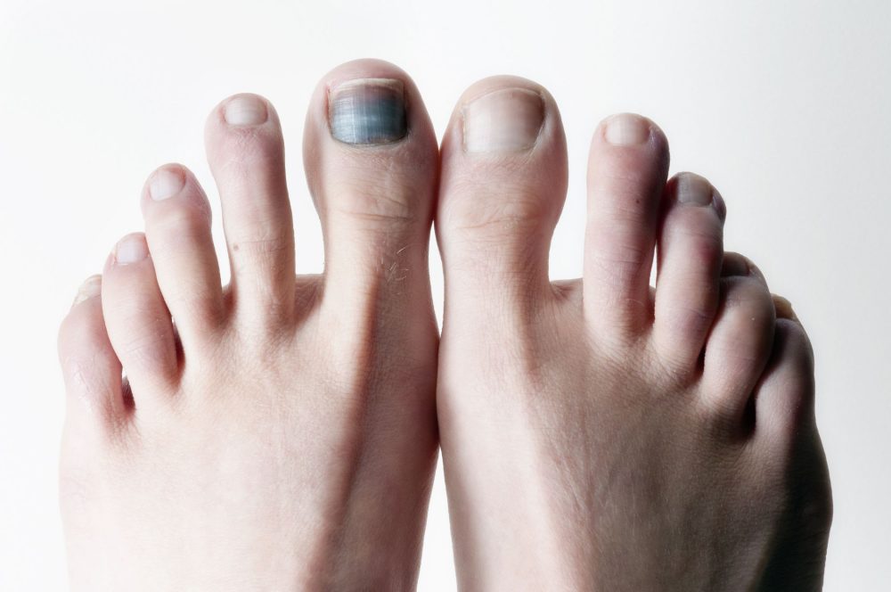 6 علت احتمالی سیاه شدن ناخن پا + درمان و پیشگیری از سیاهی ناخن پا