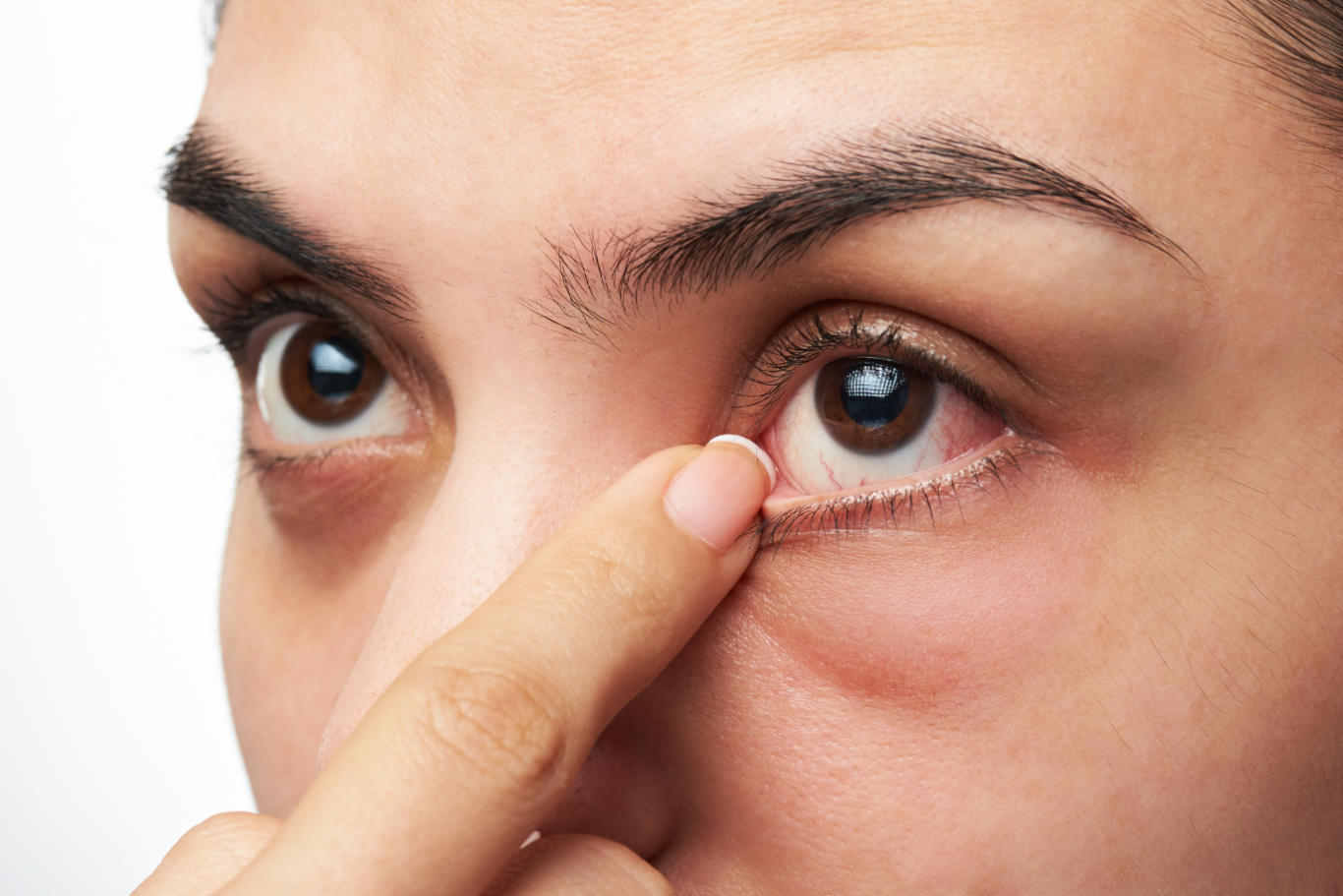 6 عفونت چشم شایع در دوران بارداری. علائم و درمان + 8 نکته برای پیشگیری از عفونت