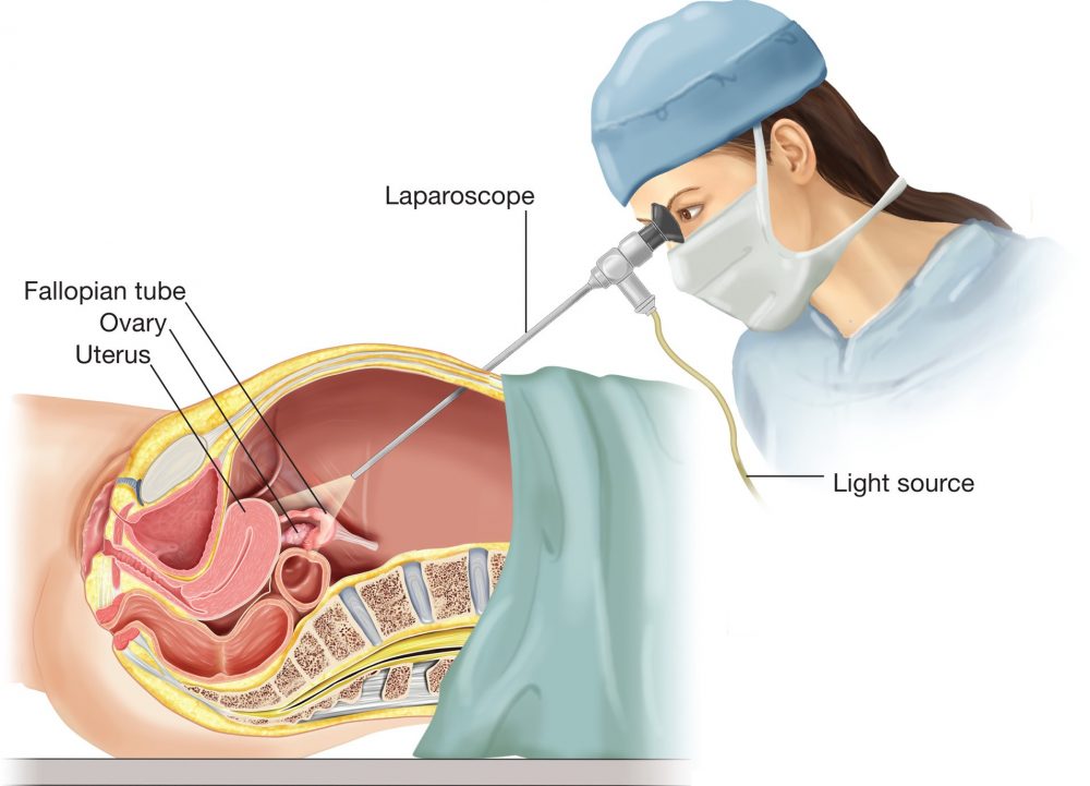عمل لاپاروسکوپی و درمان نا باروری: مزایا، عوارض و خطرات