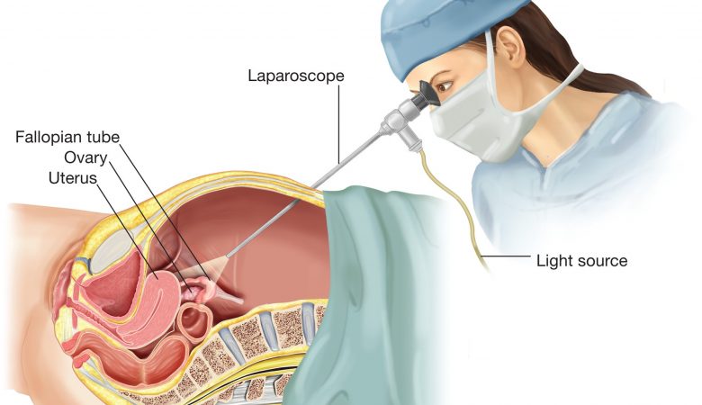 عمل لاپاروسکوپی و درمان نا باروری: مزایا، عوارض و خطرات