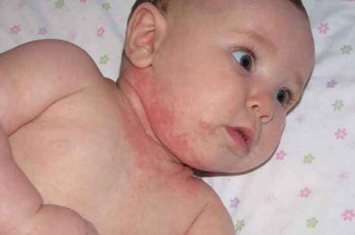 انواع واکنشهای آلرژیک در نوزادان