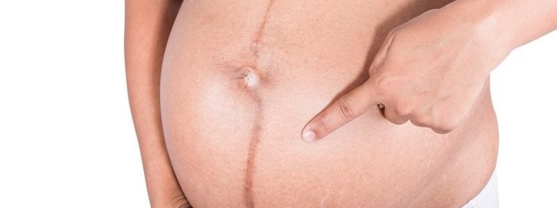 خط روی شکم در دوران بارداری خط لینا نیگرا