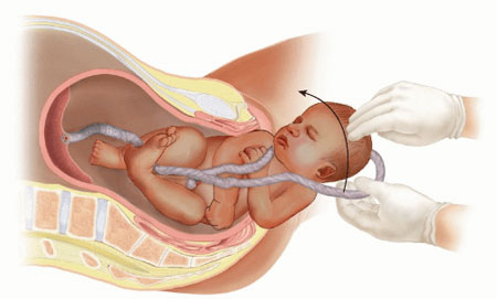 درمان پیچش بند ناف به دور گردن جنین