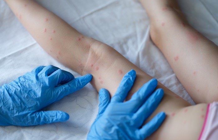 انواع حساسیت پوستی در کودکان و متخصص آن