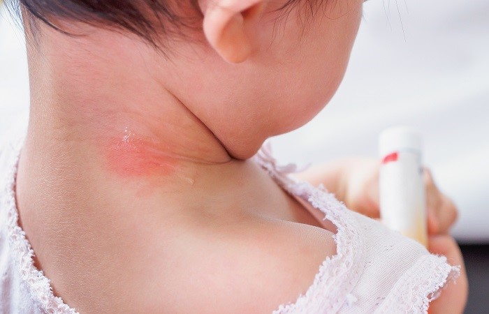 چگونه در برابر بیماری های پوستی مراقب کودکان خود باشیم (نکات بهداشتی)