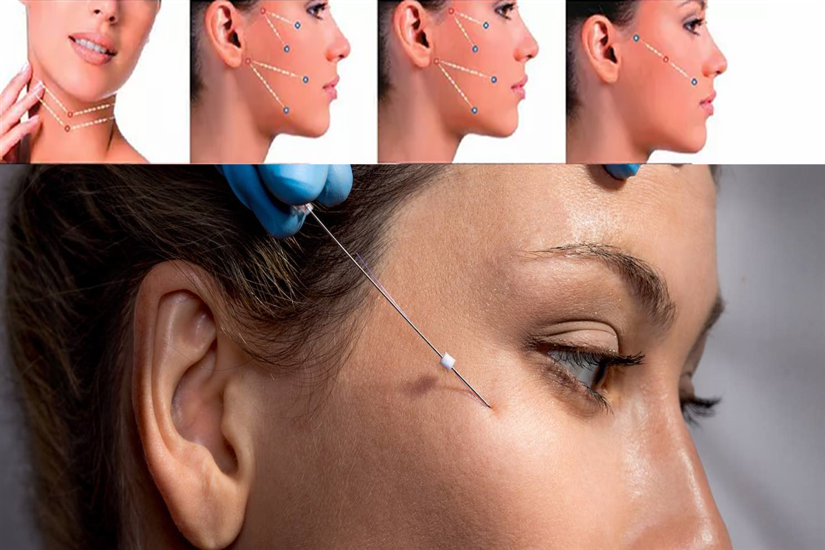 لیفت ابرو با نخ در تهران با دکتر میعاد مهدوی