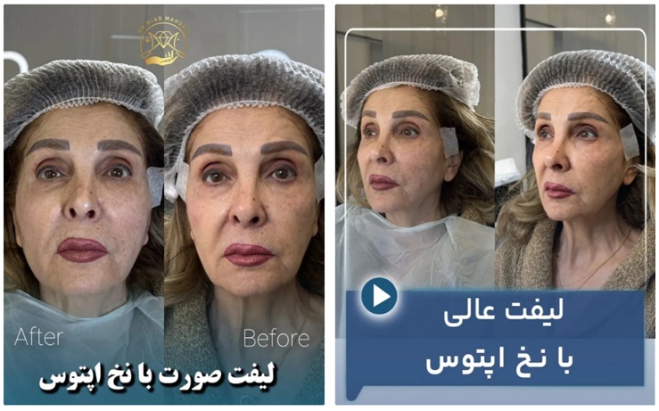 بهترین دکتر لیفت صورت با نخ دکتر میعاد مهدوی