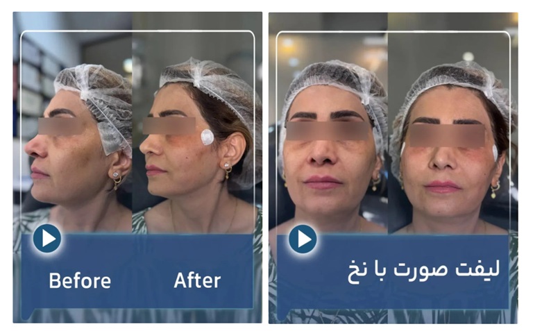 قبل و بعد لیفت صورت با نخ دکتر میعاد مهدوی